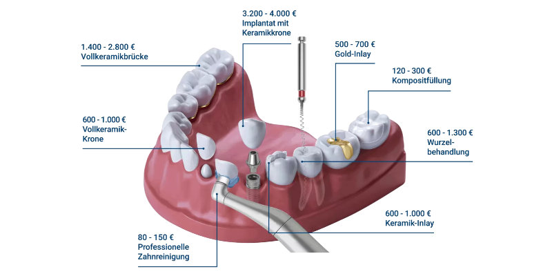 DFV Zahnschutz Exklusiv Versicherung